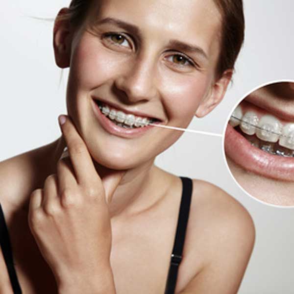 Les brackets céramiques